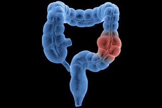 The Alarming Tide of Colorectal Cancer in Younger Adults