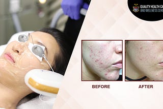 The Effectiveness of IPL laser Treatment Nowadays