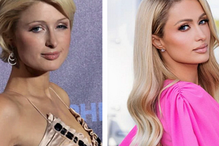 Paris Hilton Aesthetic Procedures and Nose Reconstruction