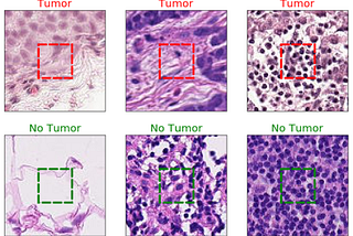Convolutional Neural Network for Detecting Cancer Tumors in Microscopic Images