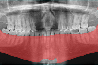 Mandible Segmentation from Panoramic X-Ray