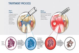 Is Periowave Gum Disease Treatment Right For Me?