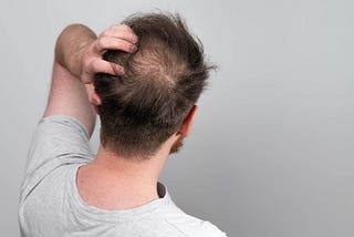 The Science Behind Crown Hair Transplantation in Turkey