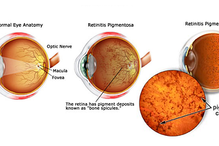 Retinitis Pigmentosa Treatment