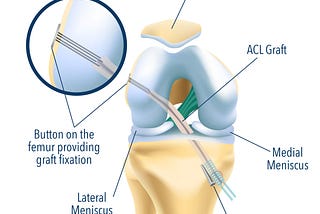 Get Back on Track with Top-Notch Torn ACL Surgery