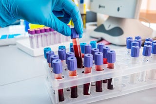 Blood test shows promising results in detecting early-stage Alzheimer’s