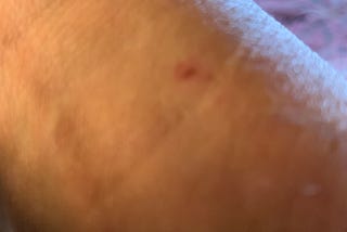 close up of author’s wrist with small scar