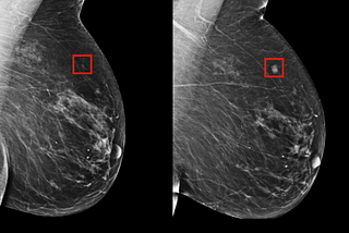 Can breast cancer be detected before it actually happens?