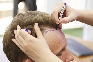 Breaking Down Hair Transplant Costs in Turkey — What You Need to Know!