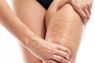 Facts and Myths About Cellulite