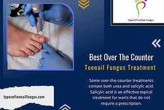 Best Over The Counter Toenail Fungus