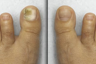 7 Astonishing Steps to Beautiful, Fungus-Free Toes!