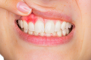 What is types of periodontal disease?