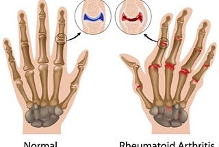 Arthritis