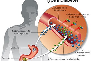 Understanding Type 2 Diabetes