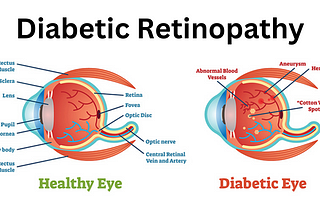 Diabetic Retinopathy:
