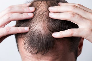 Everything You Need To Know About Hair Loss