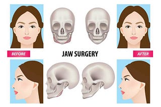 Why Do You Need Square Jaw Reduction Surgery?