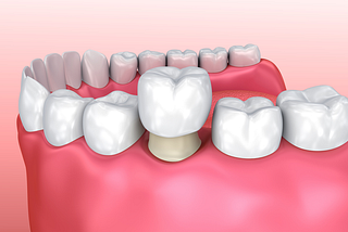 Common Myths about Your Wisdom Teeth