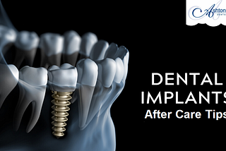 Dental Implants After Care Tips at Home