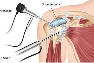 Here’s Everything to Know About Shoulder Arthroscopy