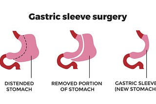 Gastric Sleeve Surgery in Turkey: A Life-Changing Journey for African Patients