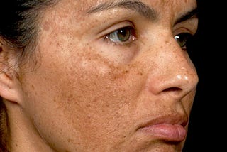 Face with Melasma