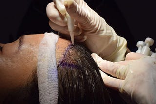 Why Hair Transplants Without Shaving are the Future of Hair Restoration
