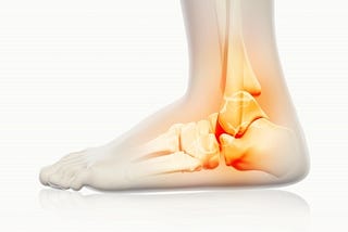 Ankle sprain