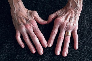 Rheumatoid Arthritis Causes , Diagnosis and Symptoms