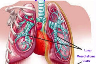 Stage 4 Mesothelioma Cancer Symptoms | Mesothelioma