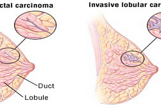 A GUIDE TO INVASIVE DUCTAL CARCINOMA