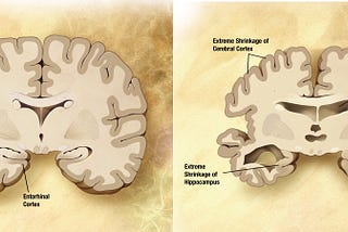 An Overview of Alzheimer’s Disease