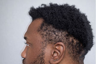 Afro-textured hair showing natural curl pattern and visible scalp areas, illustrating how visual density may differ from measured follicular density.