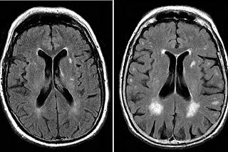 Brain MRI Segmentation with Segment Anything Model (SAM) Part 1: Background — Data Preparation