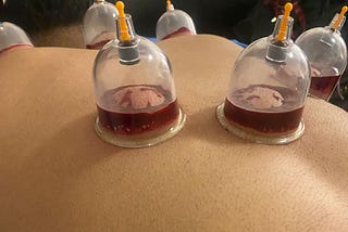 Benefits of Abdominal Hijama points no 137, 138, 139, 140, 141, 142