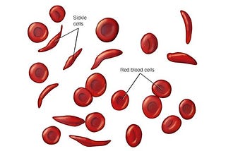 Sickle cell anaemia