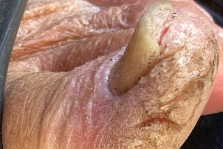 TOES