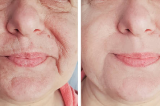 wrinkles, get rid of wrinkles naturally, wrinkles solution
