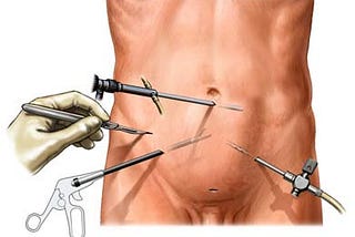 Why Laparoscopic Surgery Is Best In Case Of Sports Hernia?