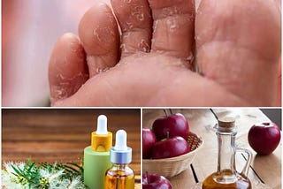 home remedies for athlete’s foot, athlete’s foot treatment, athlete’s foot symptoms, athlete’s foot home remedy, athlete’s foot pictures, natural