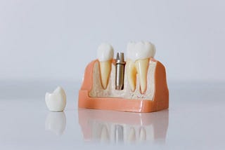 The Benefits of Dental Implants Compared to Dentures or Bridges