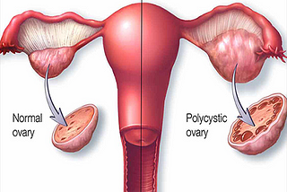 PCOS in women- Causes,  Myths , and Solutions