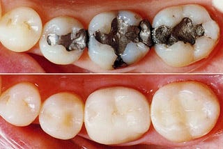 Tooth Coloured Fillings