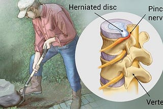 How I got through slipped/herniated disc injury