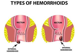 Hemorrhoids After Giving Birth: Prevalence and Causes
