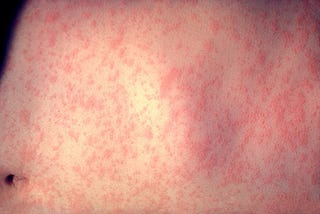 Measles — A Preventable Deadly Neurological and Respiratory Disease