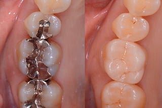 Want to replace your Amalgam silver fillings?‬