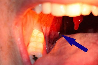 6 Home Natural Treatments For Tonsil Stones You Probably Didn’t Know!