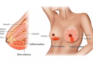 महिलाओं के लिए स्तन देखभाल: स्वास्थ्य और कल्याण सुनिश्चित करना